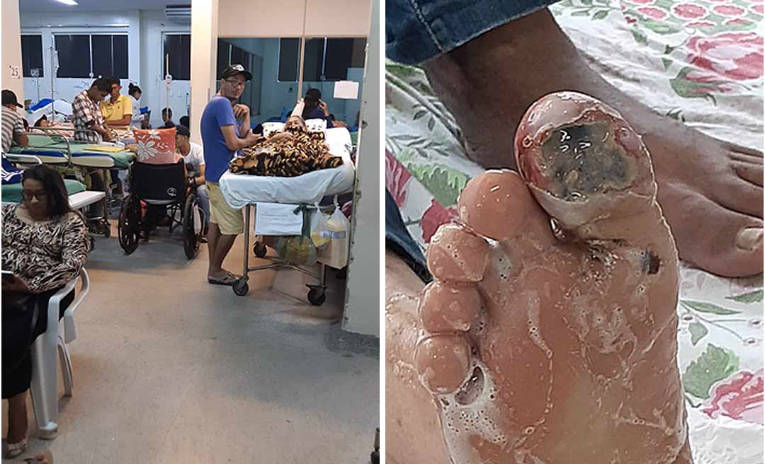 Paciente com dedo necrosado é internado “em pé” no Pronto Socorro