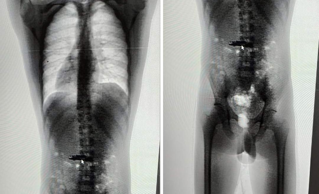 Preso que engoliu celular em presídio do Acre será submetido a cirurgia no PS para retirada do aparelho