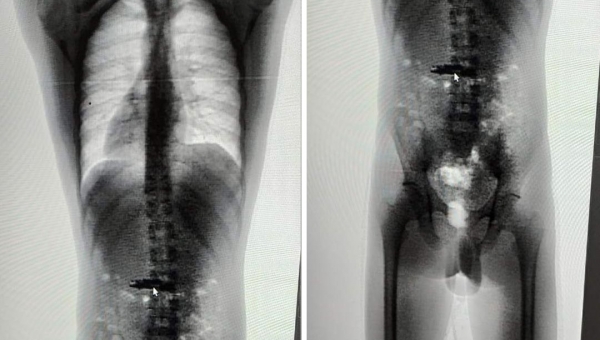 Preso que engoliu celular em presídio do Acre será submetido a cirurgia no PS para retirada do aparelho