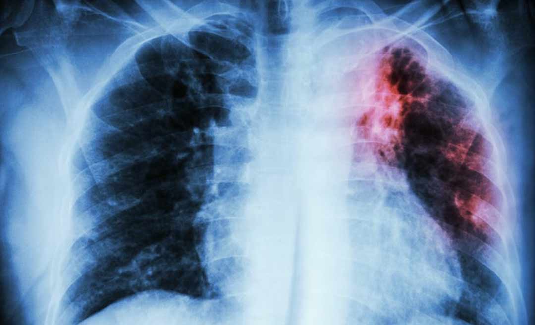 China alerta para nova pneumonia mais mortal que a covid-19