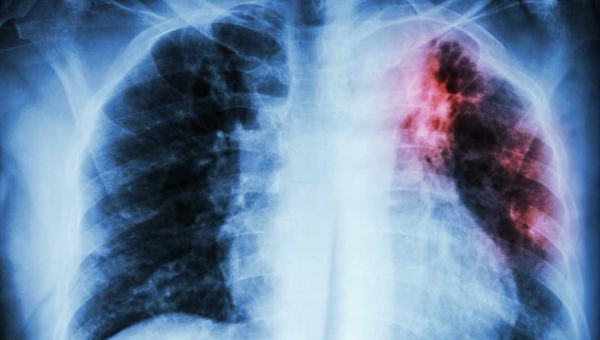 China alerta para nova pneumonia mais mortal que a covid-19