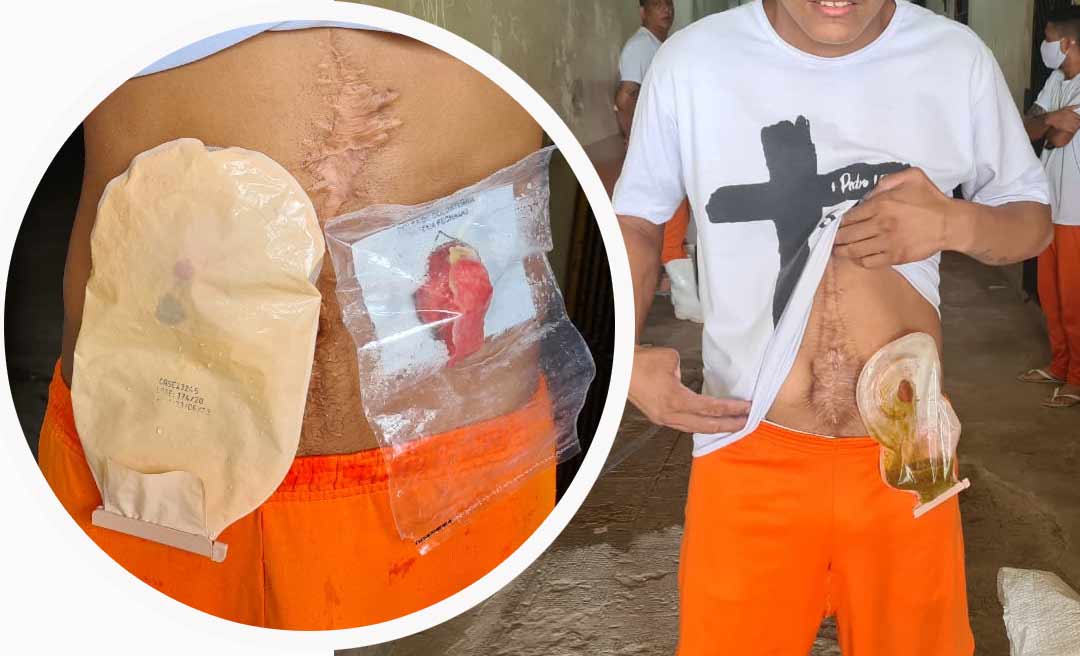 Preso no Acre espera retirada de bolsa de colostomia há três anos, denuncia promotor