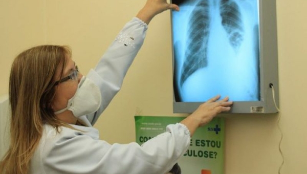 Terceiro maior percentual de tuberculose do País, por 100 mil habitantes, é registrado no Acre