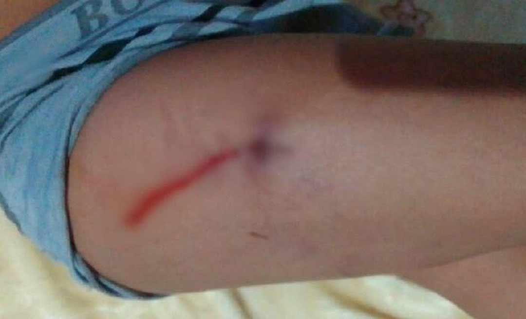 Criança de seis anos é atacada por cachorro em Sena Madureira