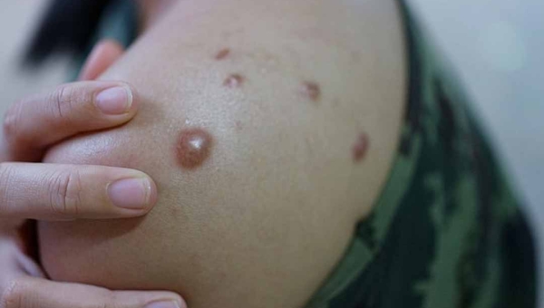 Caso suspeito de mpox é descartado e Rio Branco não tem registro confirmado da doença