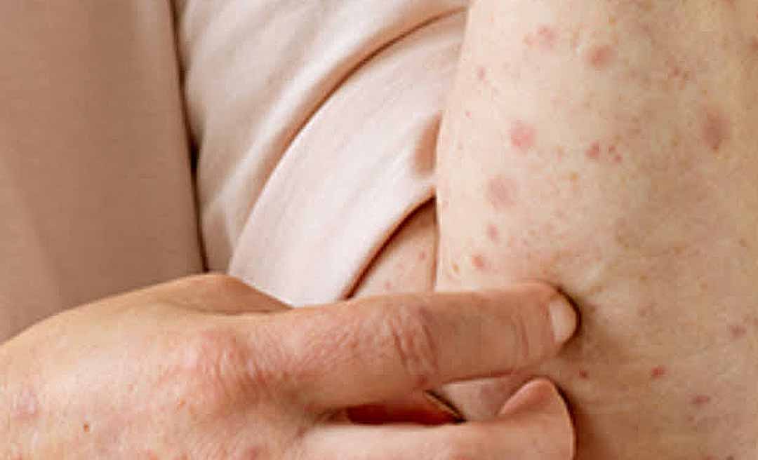 Brasil registra 88 casos de mpox em 2026; Acre não tem notificações confirmadas