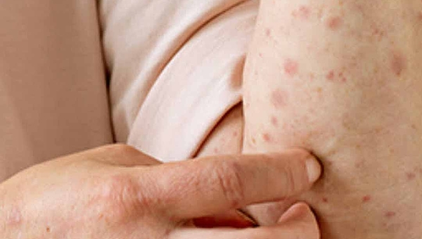 Brasil registra 88 casos de mpox em 2026; Acre não tem notificações confirmadas