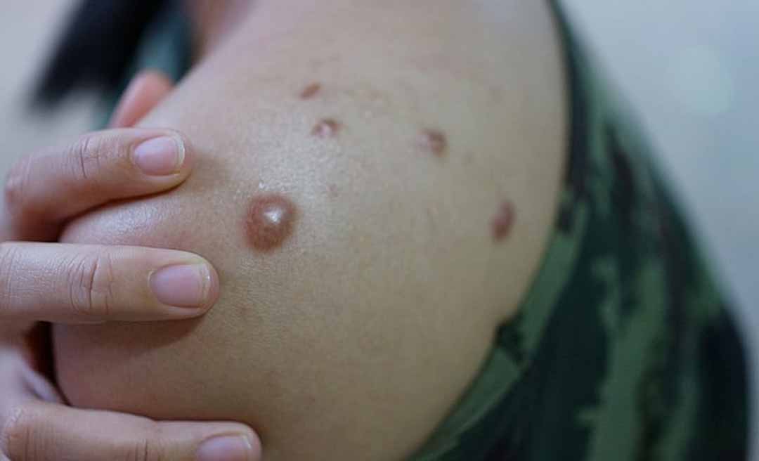 Acre confirma um caso da doença mpox em Brasileia; paciente esteve em São Paulo